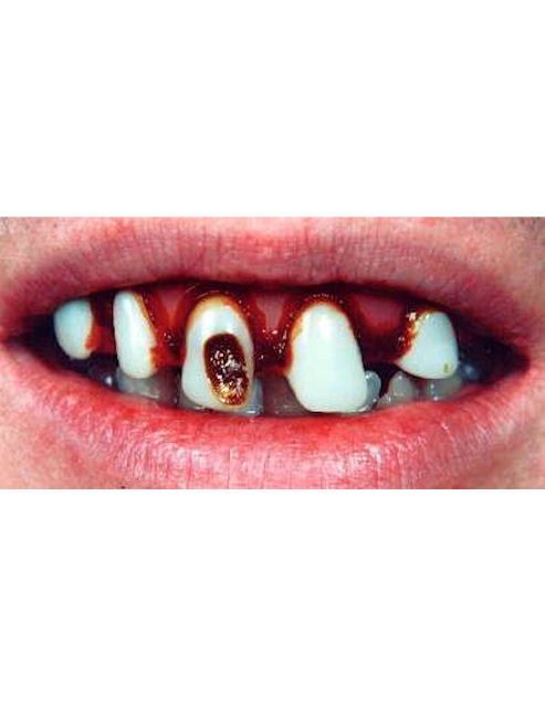 Image of Originals With Cavity (billy-bob Teeth)