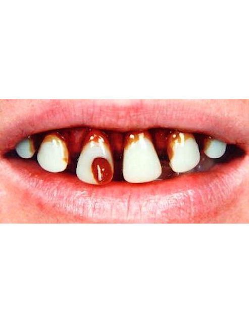Image of Caveman With Cavity (billy-bob Teeth)